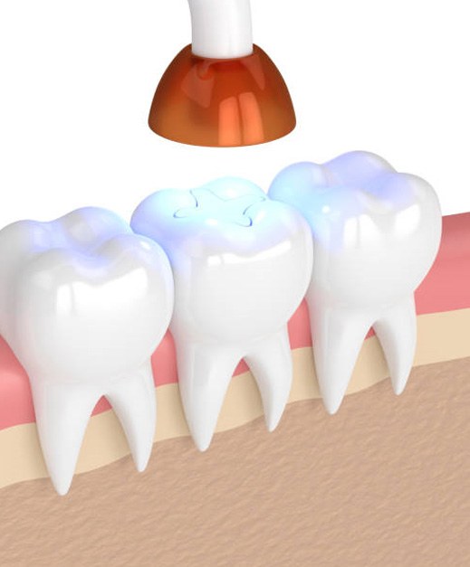 Dental light hardening a white filling