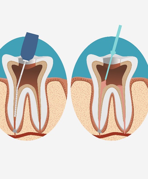 illustration for root canal therapy in Columbus 