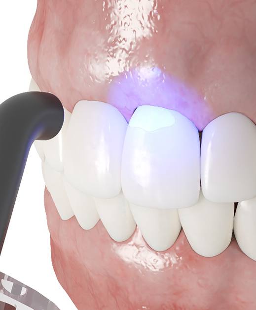 3D render of cosmetic dental bonding