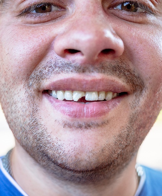 Close up of a chipped tooth