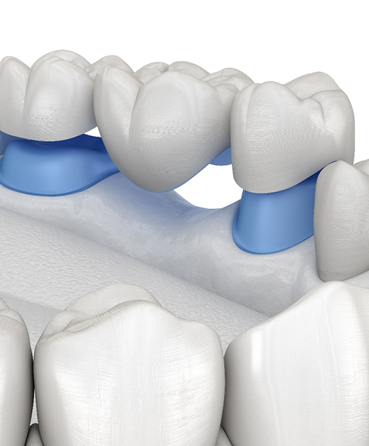 illustration of dental bridges in Columbus