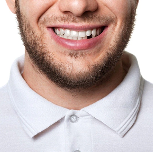Man with a missing lower tooth