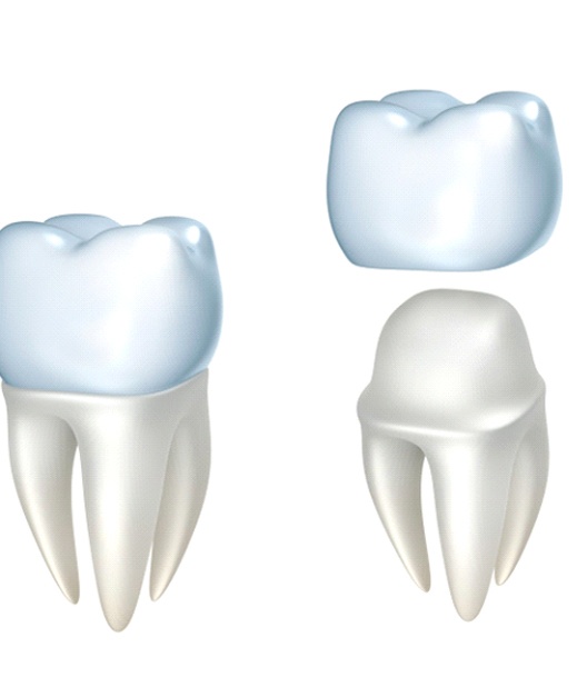 Model of an all-ceramic crown