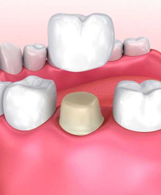 Model showing dental crown process