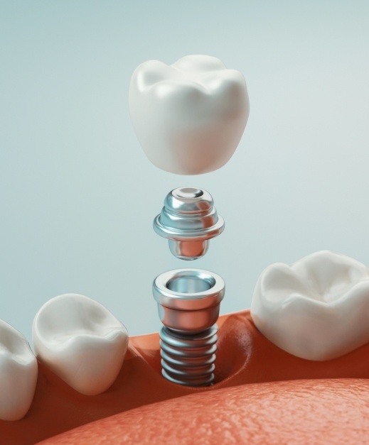 Animated smile depicting the four step dental implant process