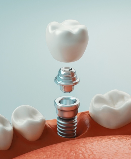 Animated smile depicting the four step dental implant process