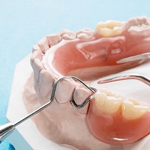 a model example of partial dentures in Columbus