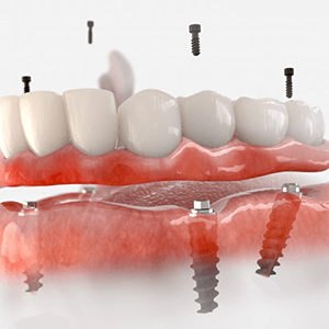 a digital illustration of implant dentures in Columbus