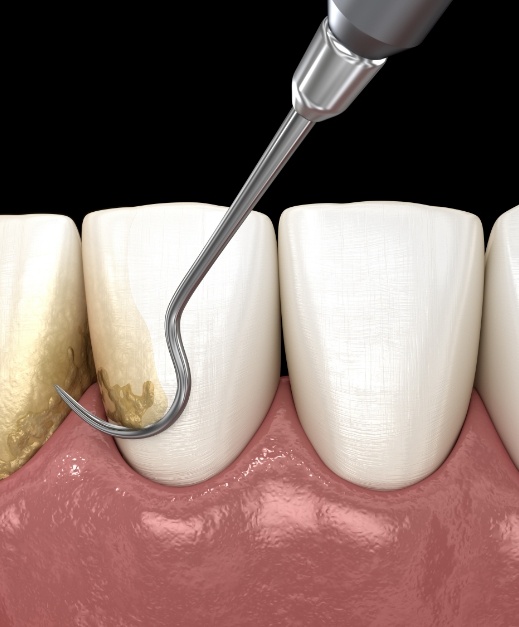 Animated smile during scaling and root planing treatment