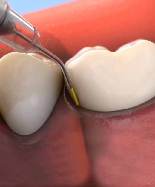 Animated smile during Arestin antibiotic therapy treatment