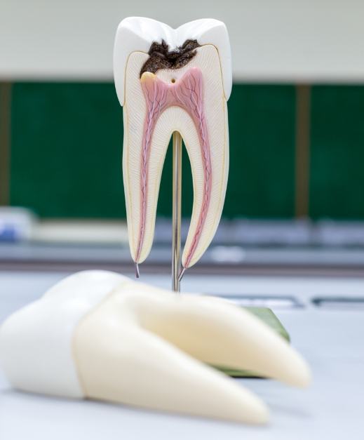 Model tooth in need of root canal therapy