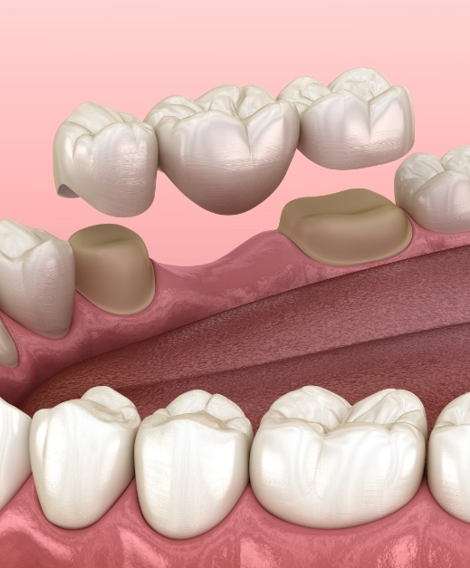 Animated smile during dental bridge placement