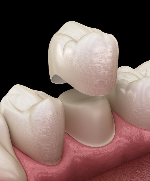 Animated smile during dental crown placement