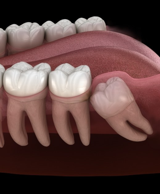 Animated smile with impacted wisdom tooth