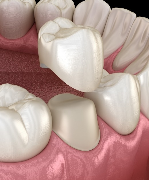 Animated smile during metal free dental crown placement