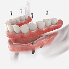 Illustration of implant denture for lower dental arch
