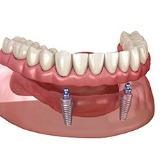 Illustration of ball-retained implant denture