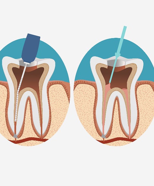 illustration for root canal therapy in Columbus