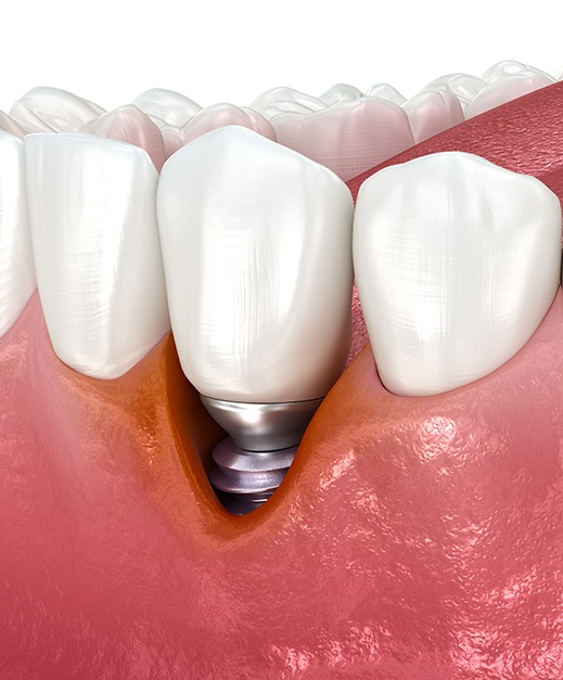 Illustration of receding gums around dental implant