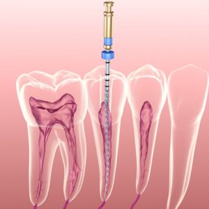 root canal 3d illustration 