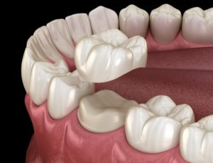 dental crown 3D illustration