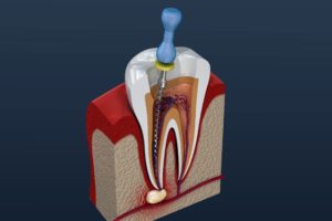 Root canal procedure