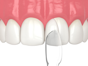 3D render of cosmetic bonding